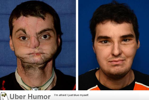 Richard Lee Norris, horribly disfigured in a shotgun accident, before and  after a face transplant surgery | Funny Pictures, Quotes, Pics, Photos,  Images. Videos of Really Very Cute animals.