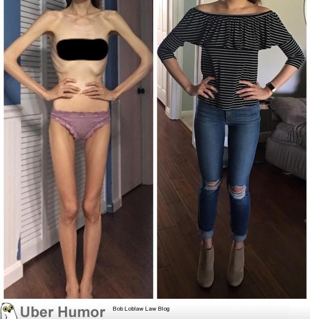 The difference of one year in recovery from anorexia. 5'6 77 pounds to 117  pounds. NSFW | Funny Pictures, Quotes, Pics, Photos, Images. Videos of  Really Very Cute animals.